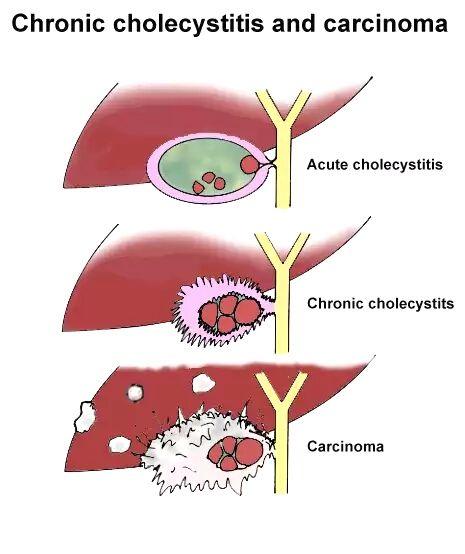 胆囊癌