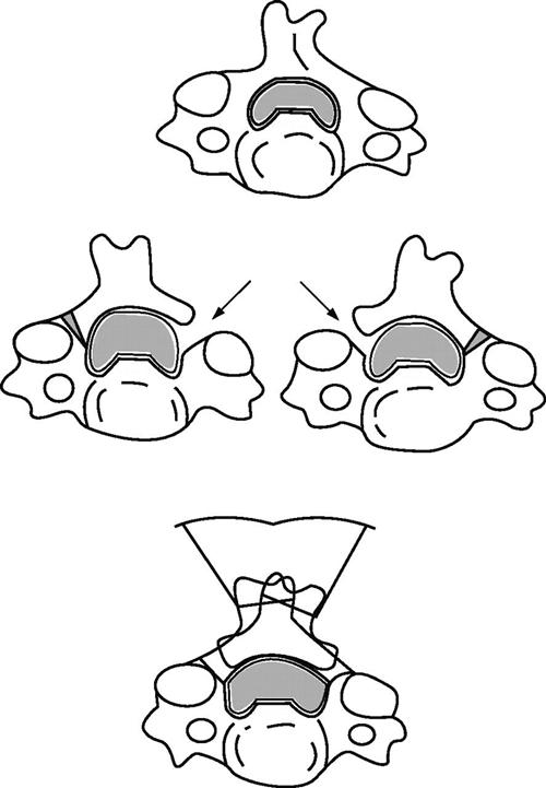 脊髓型颈椎病