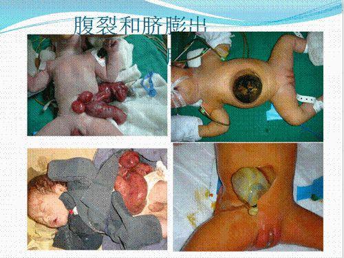 腹裂