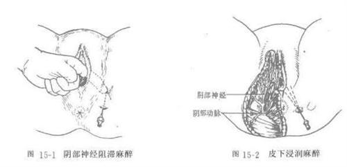 阴部神经干痛