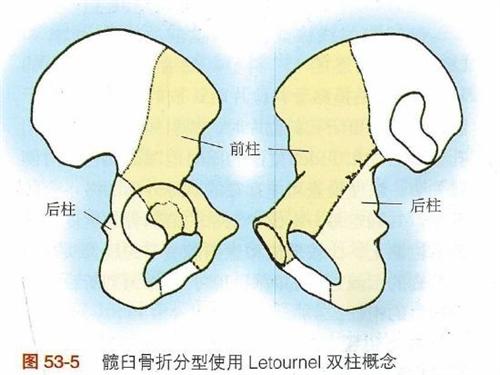 髋臼骨折
