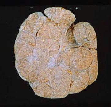 乳腺纤维腺瘤