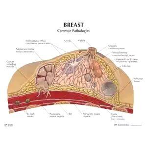 乳腺纤维腺瘤