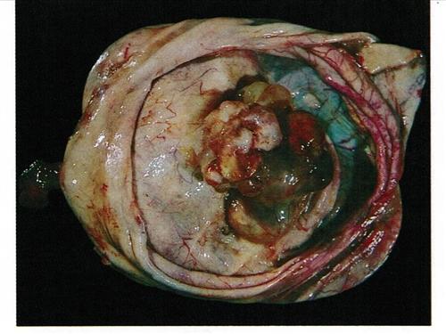 卵巢畸胎瘤