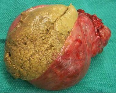 卵巢畸胎瘤