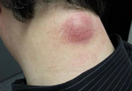 皮脂腺囊肿