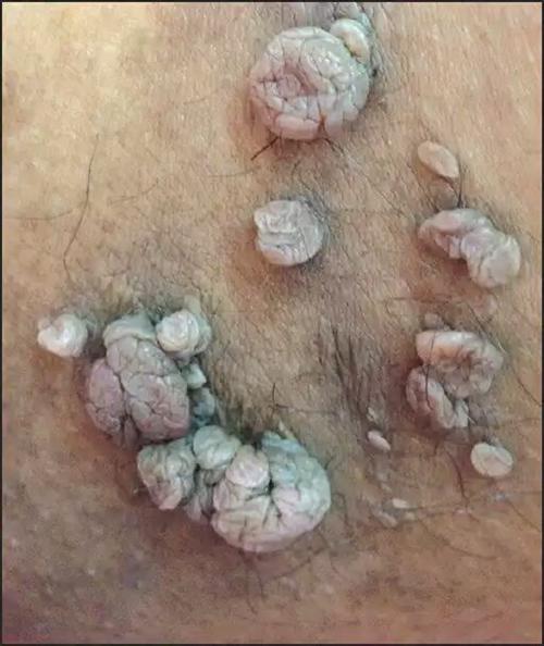 皮赘