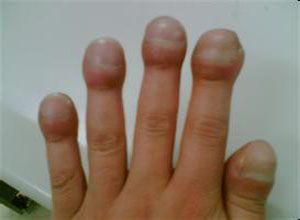 紫绀-杵状指-肝病综合征