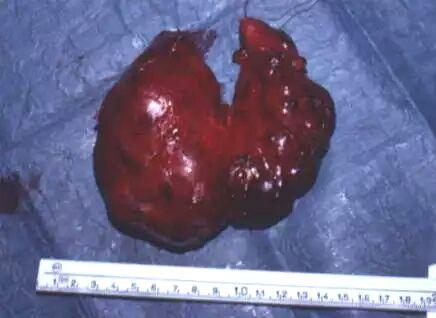 结节性甲状腺肿