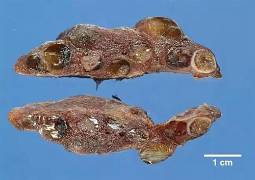 结节性甲状腺肿