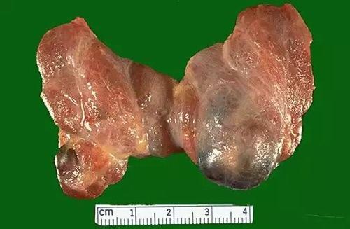 结节性甲状腺肿