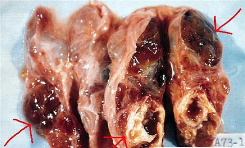 结节性甲状腺肿