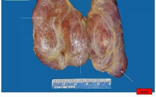 结节性甲状腺肿