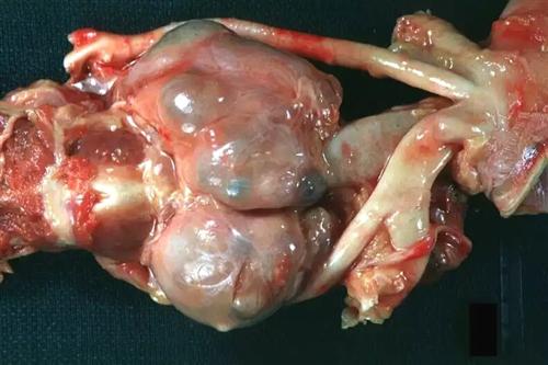 结节性甲状腺肿