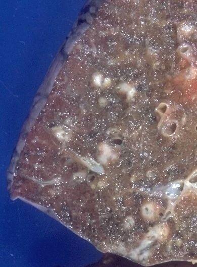 继发性肺结核