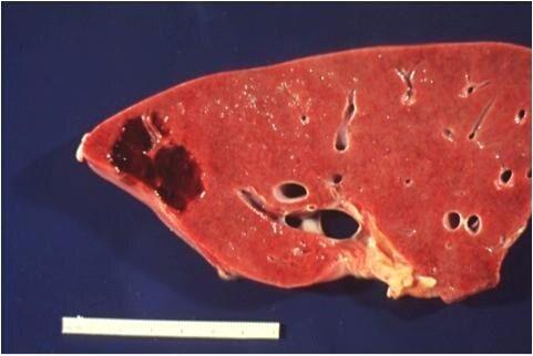 肝脏血管瘤