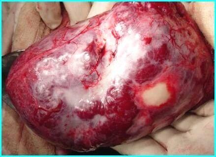 肝脏血管瘤