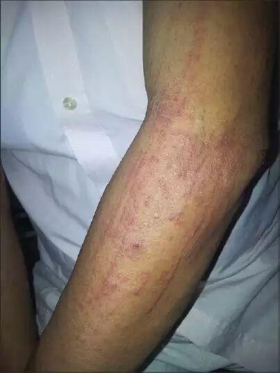 隐翅虫皮炎