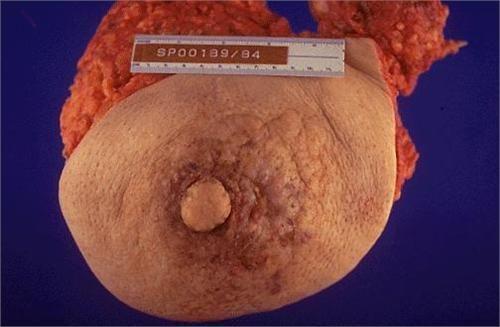 乳房纤维瘤