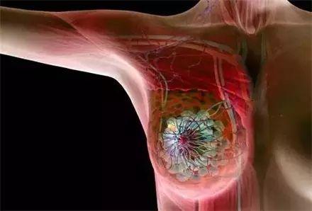 乳房纤维瘤
