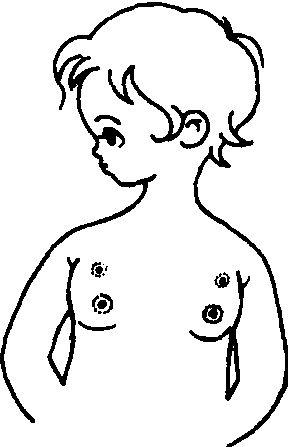 多乳头多乳房畸形