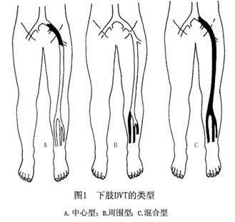 深静脉血栓形成