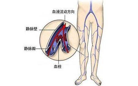 深静脉血栓形成