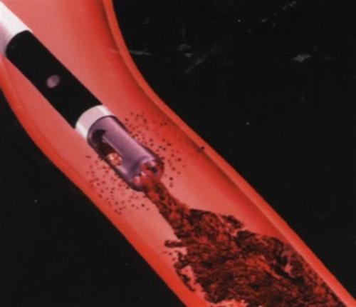 深静脉血栓形成