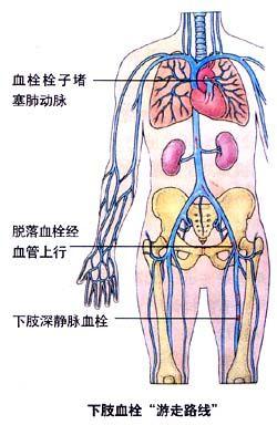 深静脉血栓形成