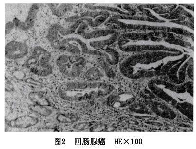 十二指肠腺癌
