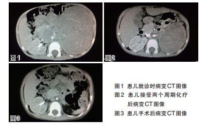 小儿肾母细胞瘤