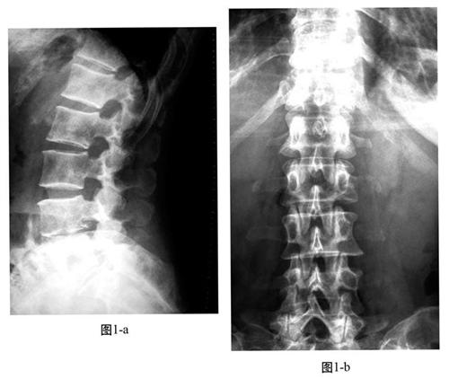 转移性骨肿瘤