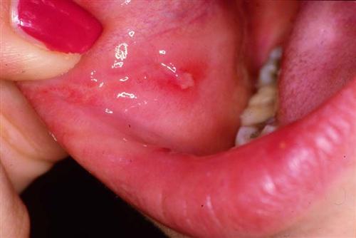 复发性阿弗他性口腔炎