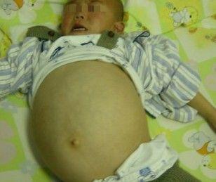 小儿肾母细胞瘤