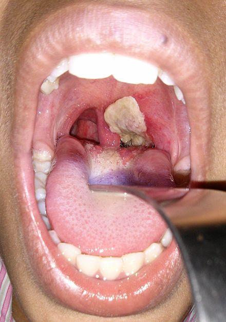 白喉是什么传染病