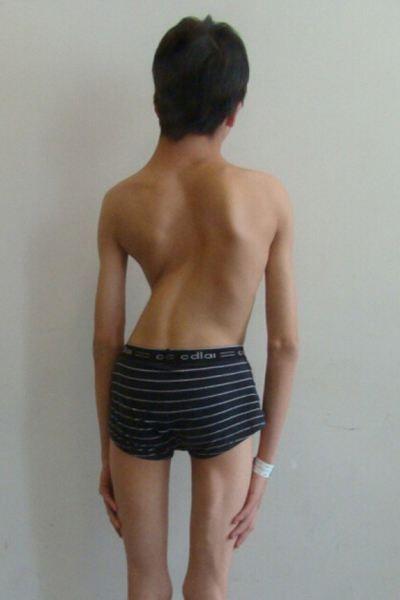 脊柱侧弯