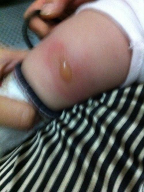 虫咬性皮炎
