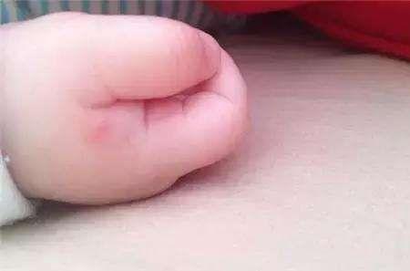 虫咬性皮炎
