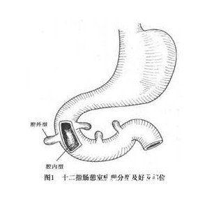 十二指肠憩室
