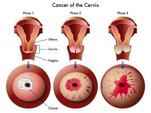 妊娠合并宫颈癌