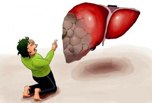 戊型病毒性肝炎