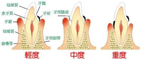 牙周萎缩