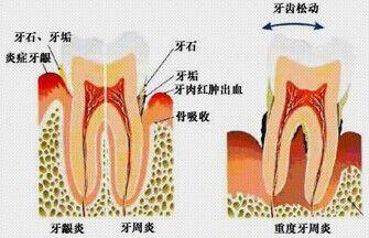 牙周萎缩