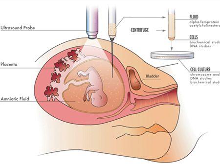 羊水穿刺