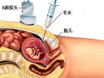 羊水穿刺