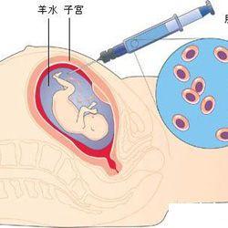 羊水穿刺