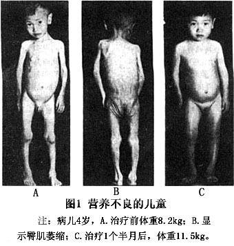 进行性骨干发育不良