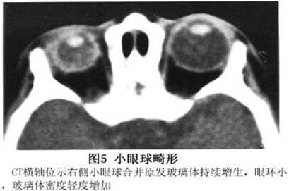 眼眶寄生虫囊肿