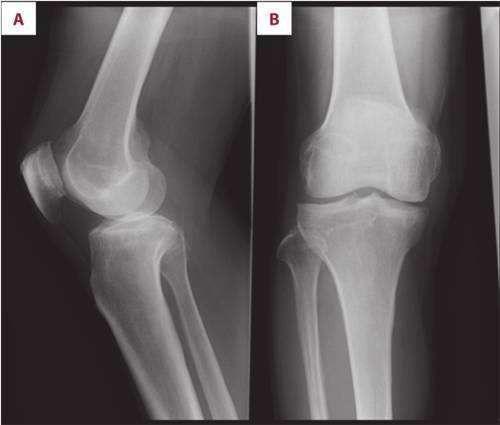 膝关节骨性关节炎
