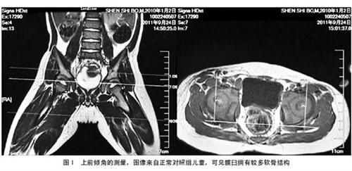 进行性骨干发育不良
